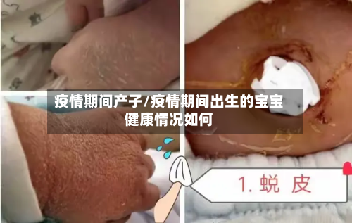 疫情期间产子/疫情期间出生的宝宝健康情况如何